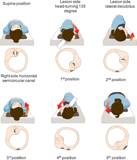 耳石症手法复位步骤图片